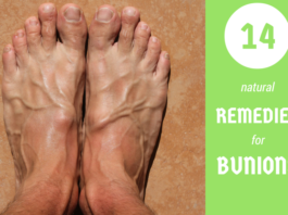 14 home remedies for bunions
