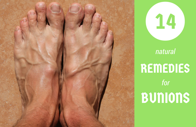 Top 14 Ways To Get Rid Of Bunions Without Surgical Procedure