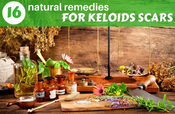 how to get rid of keloids scars- 16 remedies