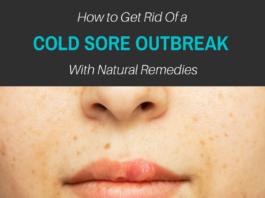 cold sore remedies