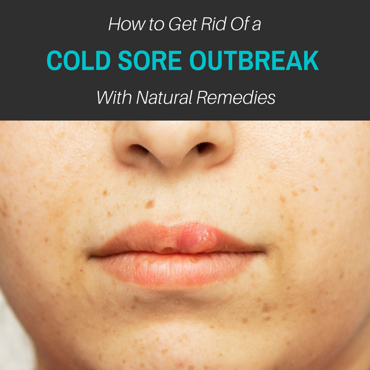 20 Home Remedies to Get Rid and Inhibit a Cold Sore Outbreak